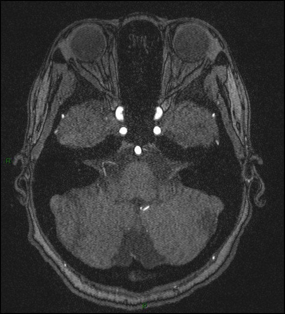 Cerebral fat embolism (Radiopaedia 35022-36525 Axial TOF 44).jpg