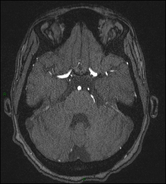 Cerebral fat embolism (Radiopaedia 35022-36525 Axial TOF 61).jpg