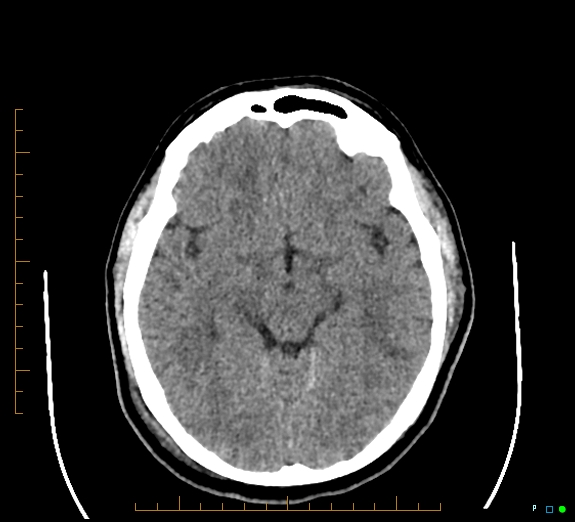 Cerebral fat embolism (Radiopaedia 85521-101220 Axial non-contrast 29).jpg