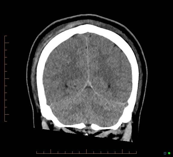 Cerebral fat embolism (Radiopaedia 85521-101224 Coronal non-contrast 47).jpg
