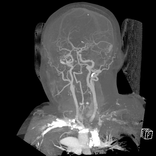 File:Cerebral hemorrhage secondary to arteriovenous malformation (Radiopaedia 33497-34571 A 5).png