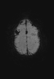 File:Cerebral hemorrhagic contusions- temporal evolution (Radiopaedia 40224-42757 Axial SWI 29).png