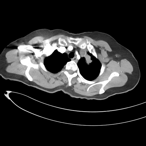 Cerebral metastases (Radiopaedia 33041-34055 A 11).png
