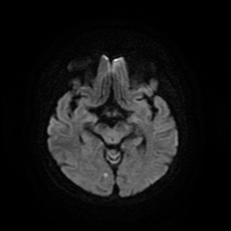 Cerebral metastases - melanoma (Radiopaedia 80972-94522 Axial DWI 46).jpg