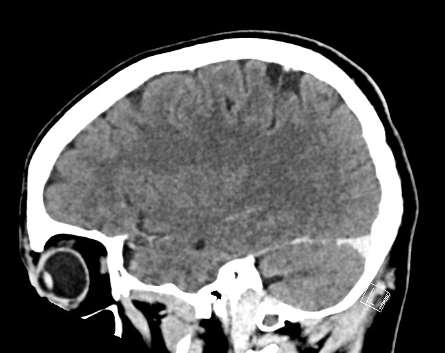 Cerebral metastases - testicular choriocarcinoma (Radiopaedia 84486-99855 F 41).jpg