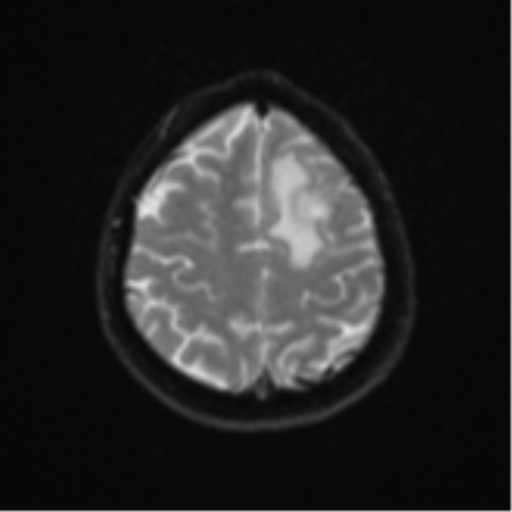 File:Cerebral metastases mimicking abscesses (Radiopaedia 45841-50131 Axial DWI 23).png