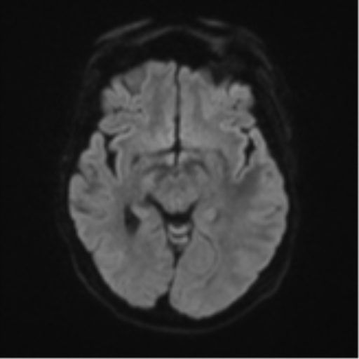 Cerebral metastasis (Radiopaedia 46744-51248 Axial DWI 40).png