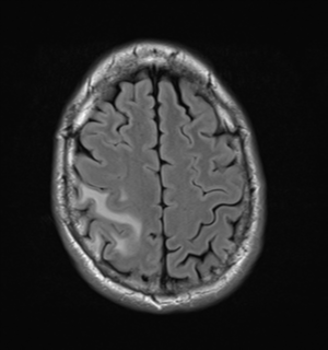 File:Cerebral metastasis - melanoma (Radiopaedia 54718-60954 Axial FLAIR 24).png