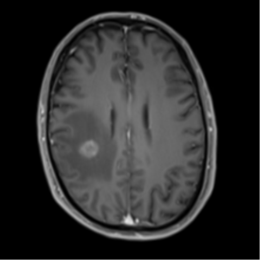 File:Cerebral metastasis - melanoma (Radiopaedia 54718-60954 Axial T1 C+ fat sat 35).png