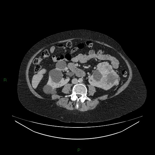 File:Cerebral metastasis from renal cell carcinoma (Radiopaedia 82306-96378 A 99).jpg