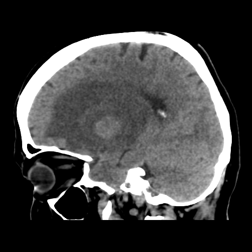 Cerebral metastasis to basal ganglia (Radiopaedia 81568-95412 E 24).png