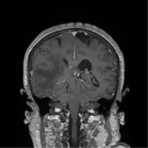 File:Cerebral metastasis to basal ganglia (Radiopaedia 81568-95413 Coronal T1 C+ 17).png