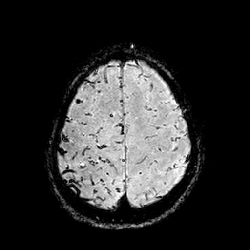 Cerebral parenchymal arteriovenous malformation (Radiopaedia 27280-27456 Axial SWI 102).jpg