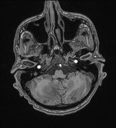 Cerebral toxoplasmosis (Radiopaedia 43956-47461 Axial T1 13).jpg