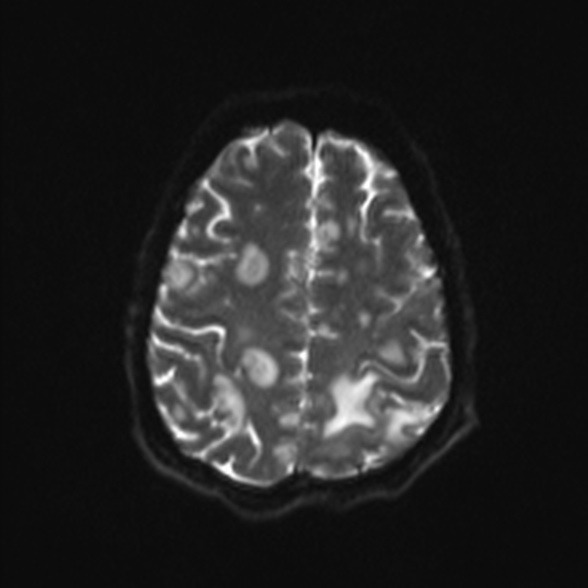 Cerebral toxoplasmosis (Radiopaedia 53993-60132 Axial DWI 21).jpg