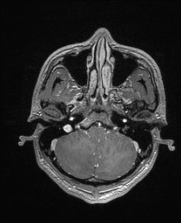 Cerebral toxoplasmosis (Radiopaedia 85779-101597 Axial T1 C+ 32).jpg