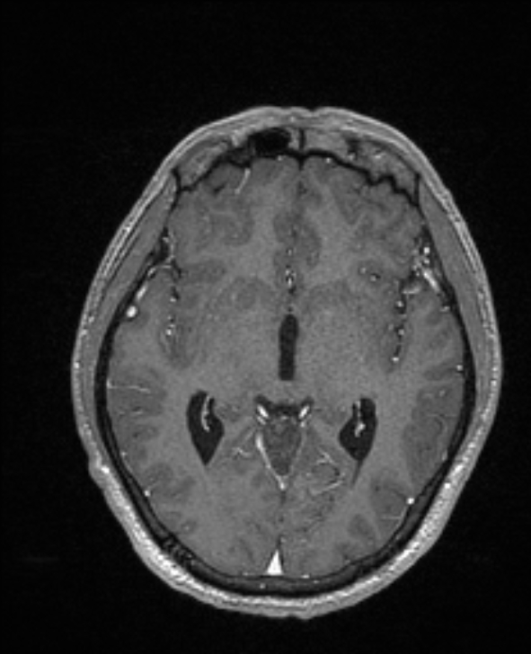 Cerebral toxoplasmosis (Radiopaedia 85779-101597 Axial T1 C+ 78).jpg