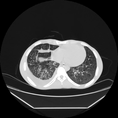 Cerebral tuberculoma (Radiopaedia 80829-94318 Axial lung window 128).jpg