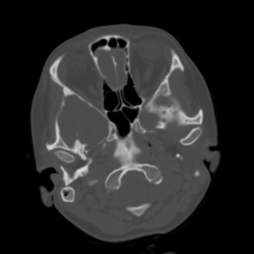 File:Cerebral tuberculosis with dural sinus invasion (Radiopaedia 60353-68018 Axial bone window 5).jpg