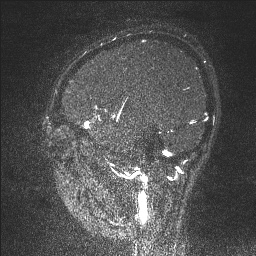 Cerebral tuberculosis with dural sinus invasion (Radiopaedia 60353-68090 Sagittal MRV 121).jpg