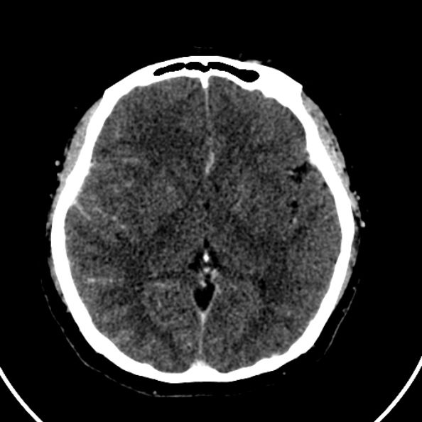 File:Cerebral venous hemorrhagic infarct from venous sinus thrombosis (Radiopaedia 55433-61883 Axial C+ delayed 78).jpg