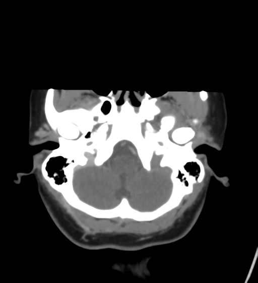 Cerebral venous infarction due to transverse sinus thrombosis (Radiopaedia 34688-36120 Axial CT venogram 10).png
