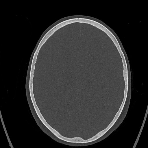 Cerebral venous infarction with hemorrhage (Radiopaedia 65343-74381 Axial bone window 118).jpg
