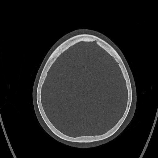 Cerebral venous infarction with hemorrhage (Radiopaedia 65343-74381 Axial bone window 150).jpg