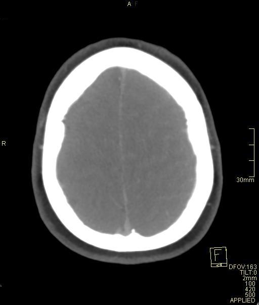 Cerebral venous sinus thrombosis (Radiopaedia 91329-108965 Axial venogram 67).jpg