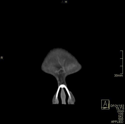 Cerebral venous sinus thrombosis (Radiopaedia 91329-108965 Coronal venogram 3).jpg