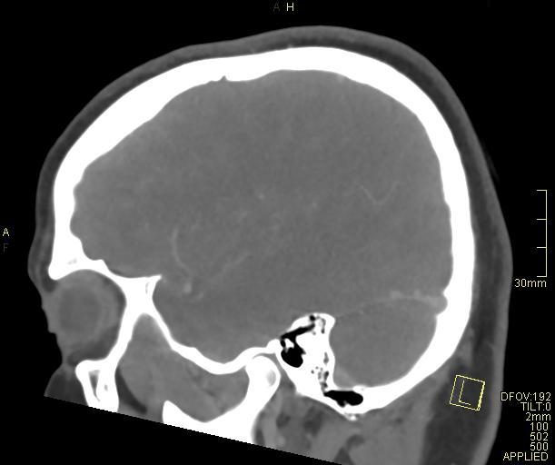 Cerebral venous sinus thrombosis (Radiopaedia 91329-108965 Sagittal venogram 19).jpg