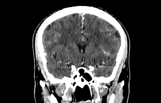 Cerebral venous thrombosis (CVT) (Radiopaedia 77524-89685 C 24).jpg