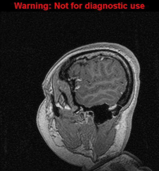 Cerebral venous thrombosis (Radiopaedia 37224-39208 Sagittal T1 C+ 21).jpg