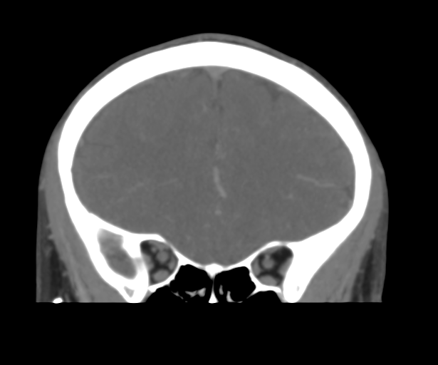 File:Cerebral venous thrombosis (Radiopaedia 38392-40467 Coronal CTA-Venogram 19).png