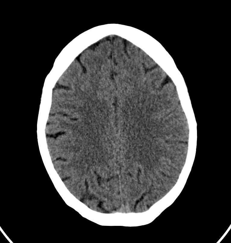 Cerebral venous thrombosis - CT only (Radiopaedia 41031-43778 Axial non-contrast 25).jpg