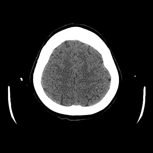 Cerebral venous thrombosis with venous hemorrhagic infarct (Radiopaedia 90354-107660 Axial non-contrast 41).jpg