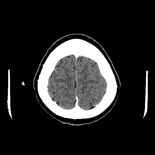Cerebral venous thrombosis with venous hemorrhagic infarct (Radiopaedia 90354-107660 Axial with contrast 145).jpg