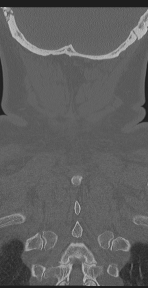 Cervical canal stenosis due to ossification of the posterior longitudinal ligament (Radiopaedia 47260-51823 Coronal bone window 60).png