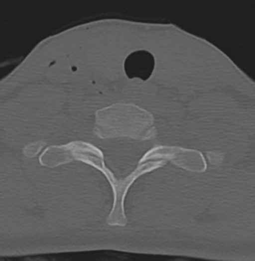 File:Cervical disc replacement (Radiopaedia 37383-39205 Axial bone window 16).png
