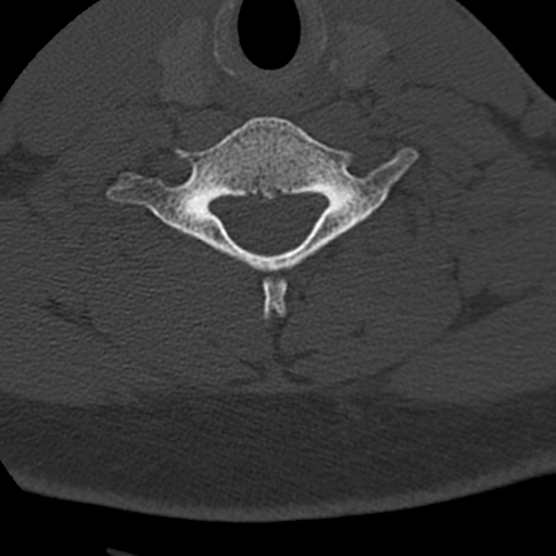 File:Cervical schwannoma (Radiopaedia 57979-64974 Axial bone window 36).png