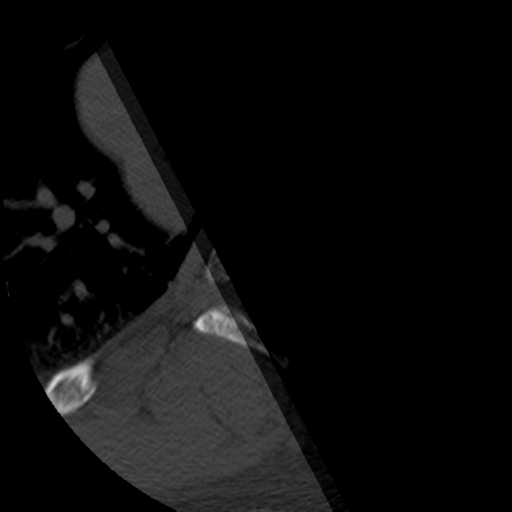 File:Cervical schwannoma (Radiopaedia 57979-64974 Axial bone window 58).png