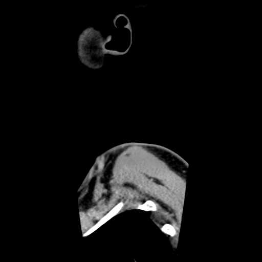 Cervical schwannoma (Radiopaedia 57979-64974 H 9).png