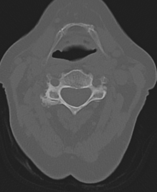 Cervical spine ACDF loosening (Radiopaedia 48998-54071 Axial bone window 25).png