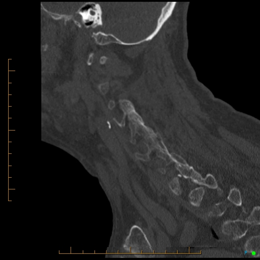Cervical spine fracture - ankylosing spondylitis (Radiopaedia 76835-88706 Sagittal bone window 33).jpg