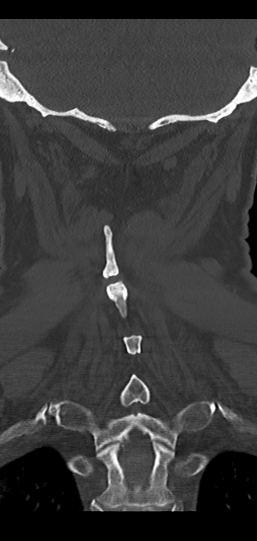 Cervical spine fracture - chalk stick (Radiopaedia 39116-41323 Coronal bone window 41).png