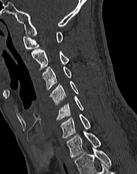 Cervical spondylodiscitis (Radiopaedia 28057-29489 Sagittal bone window 39).jpg