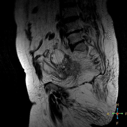 File:Cervical stump squamous cell carcinoma (Radiopaedia 48049-52858 Sagittal T2 12).jpg