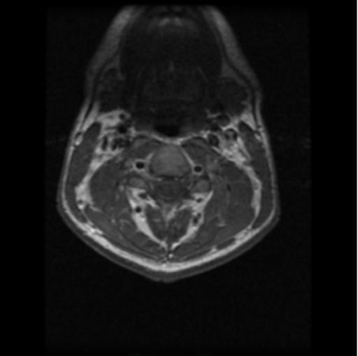File:Cervical vertebrae metastasis (Radiopaedia 78814-91667 Axial T1 C+ 16).png
