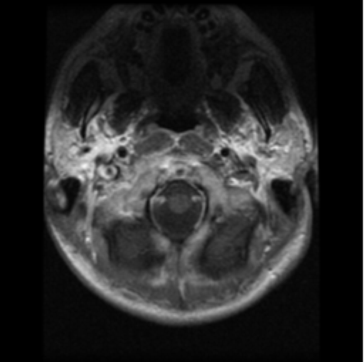 File:Cervical vertebrae metastasis (Radiopaedia 78814-91667 Axial T1 C+ 27).png