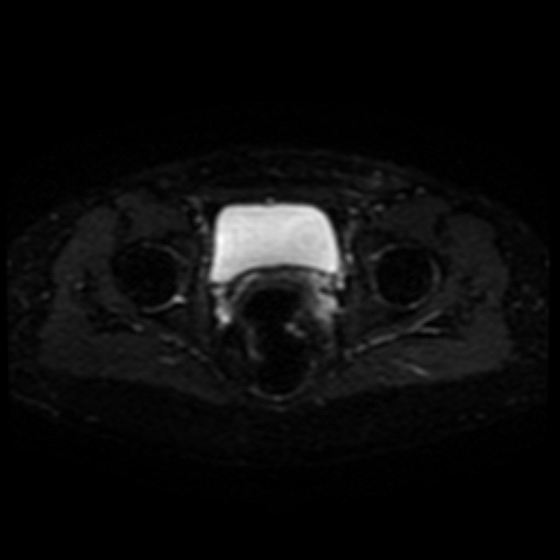Cesarian section scar endometriosis (Radiopaedia 66520-75799 Axial DWI 18).jpg